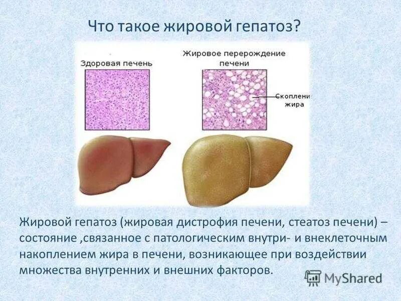 Жировая печень анализы. Жирового гепатоза печени. Жировой гепатоз печени симптомы. Жировая дистрофия печени(жировой гепатоз). Тиреотоксический гепатоз.