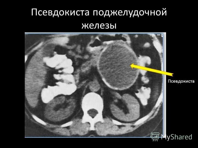 Поджелудочная железа узи норма у мужчин