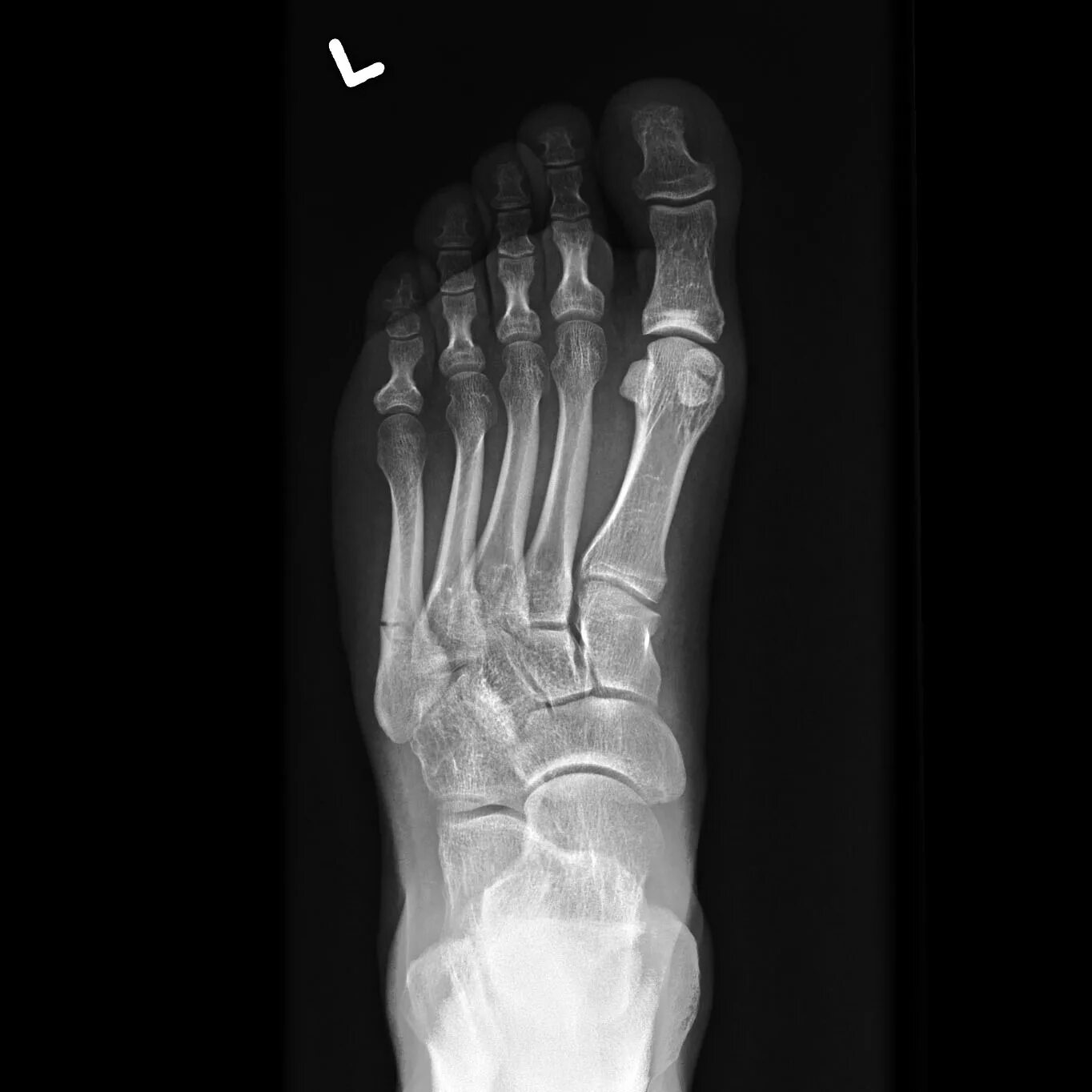 Трещина 5 букв. Здоровая пятка рентген. False Metatarsal Joint MRI.