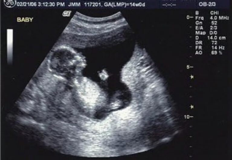 Замершая 14 недель. УЗИ 14 недель беременности. УЗИ 11-14 недель беременности. УЗИ плода на 14 неделе беременности. Ребёнок на 14 неделе беременности УЗИ.