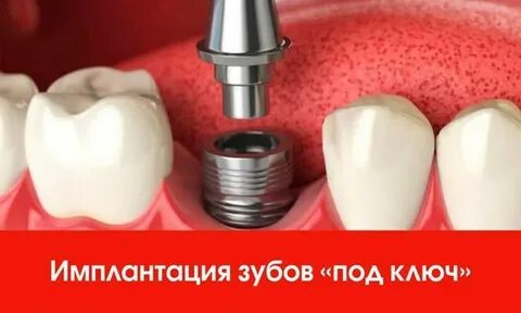 Импланты белгород