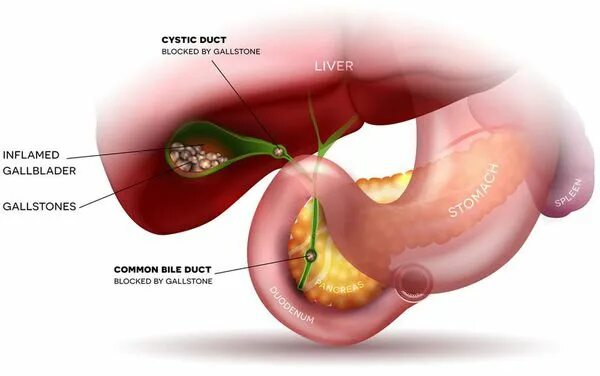 Сильно болит желчный. Холецистит желчного пузыря. Острый холецистит желчного пузыря. Холецистит воспаление желчного пузыря. ЖКБ камни желчного пузыря.