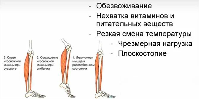 Ногу свело сильно болит. Спазмы икроножных мышц. Спазмируются икроножные мышцы. Судорога икроножной мышцы. Судорога икроножной мышцы причины.