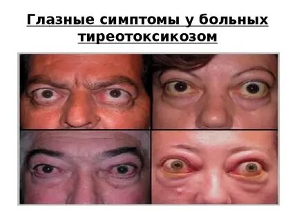 Глаза при щитовидной железе