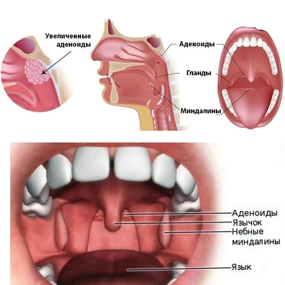 Аденоиды признаки