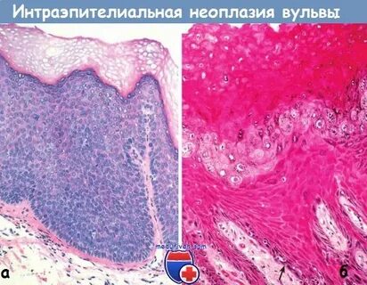 Аденома с интраэпителиальной неоплазией высокой степени