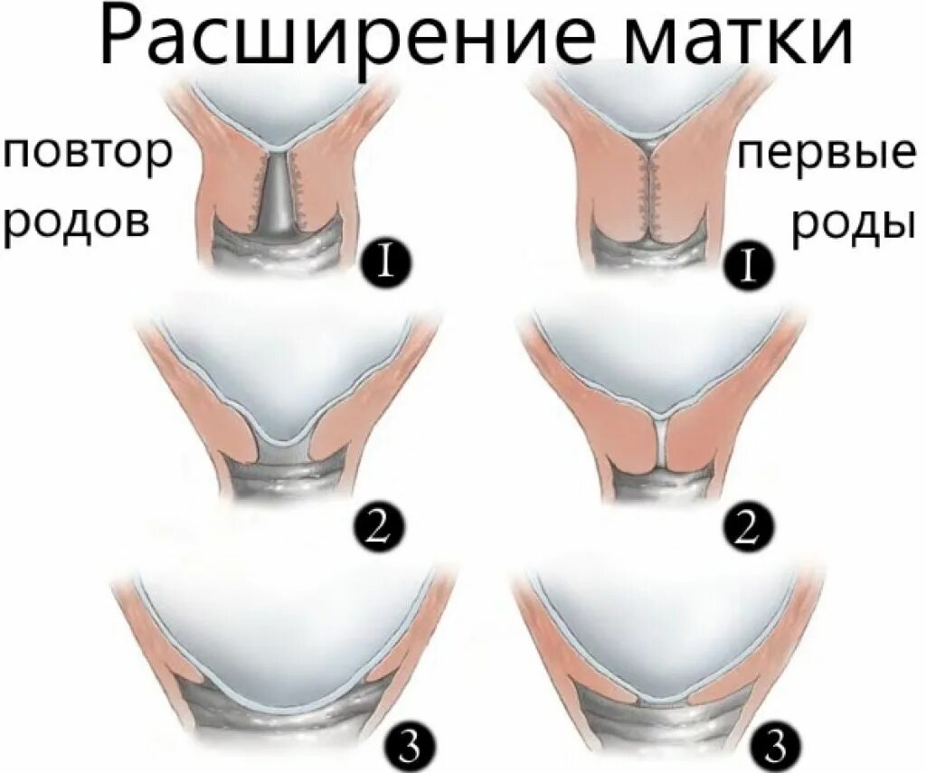 Сколько пальцев на матки. Раскрытие шейки. Как выглядит раскрытие.