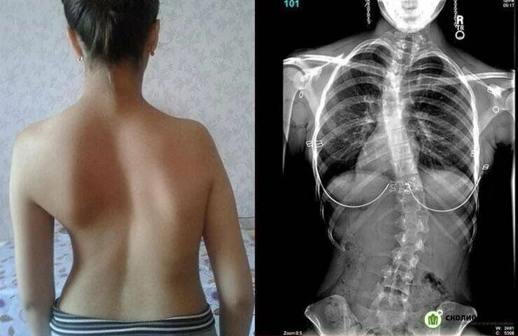 Грудной сколиоз 1 степени лечение. Левосторонний грудопоясничный сколиоз позвоночника. s образный сколиоз 2 степени грудного отдела. грудопоясничный сколиоз 1 степени. s образный сколиоз 2 степени поясничного отдела.