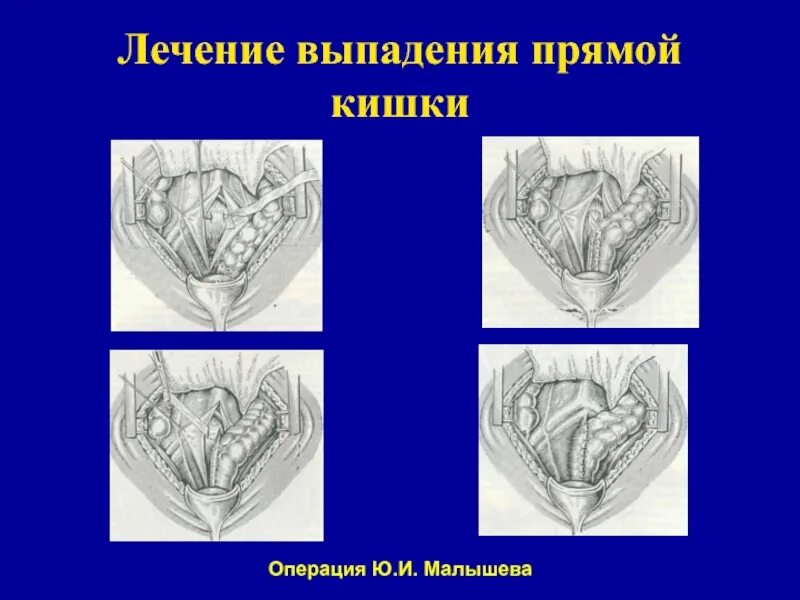 Почему выпадает кишка. Первая стадия выпадения прямой кишки. Операции при выпадении прямой кишки у детей. Опущение прямой кишки операция. Упражнения при выпадении прямой кишки у детей.