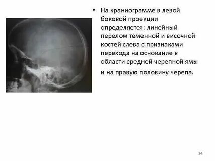Перелом височной кости