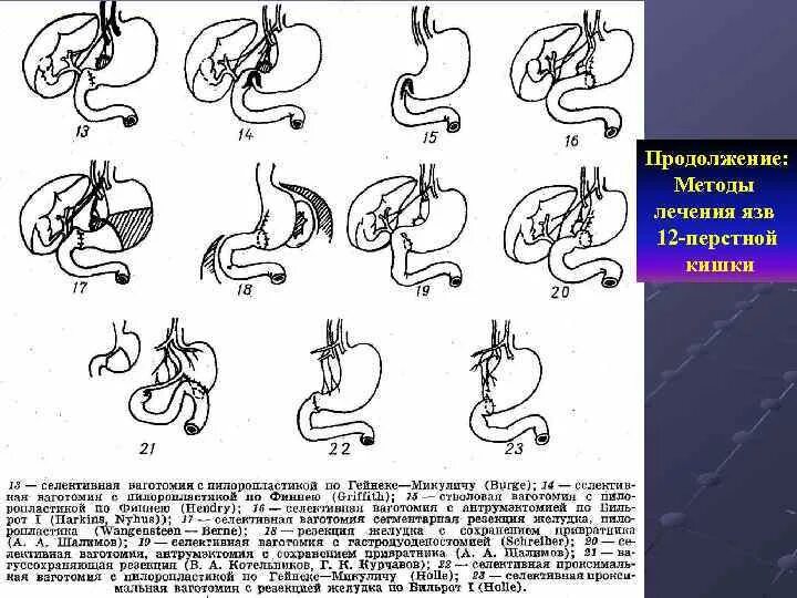 Лечение язвы желудка и 12 перстной кишки. Язва 12 перстной кишки лечение. Язвенная болезнь 12 перстной кишки лечение. Схема лечения язвы 12 перстной кишки. Хирургические методы лечения дуоденальных язв.