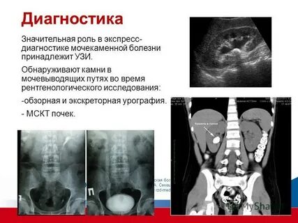 Мочекаменная болезнь диагноз
