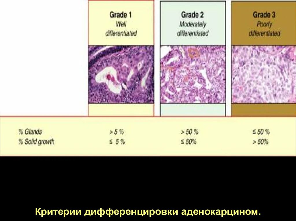 G1 опухоли. Степени дифференцировки опухоли g1 g2 g3. Умеренно дифференцированная аденокарцинома эндометрия гистология. Ацинарная аденокарцинома гистология. Аденокарцинома кишечника гистология.