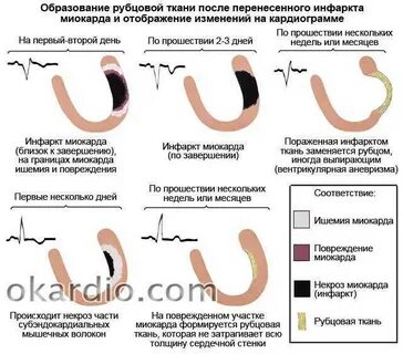 После инфаркта когда можно выходить на работу