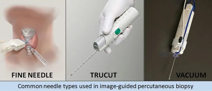 Как делают биопсию щитовидных узлов If during the examination, the doctor detects a node on the patient's thyroid gl