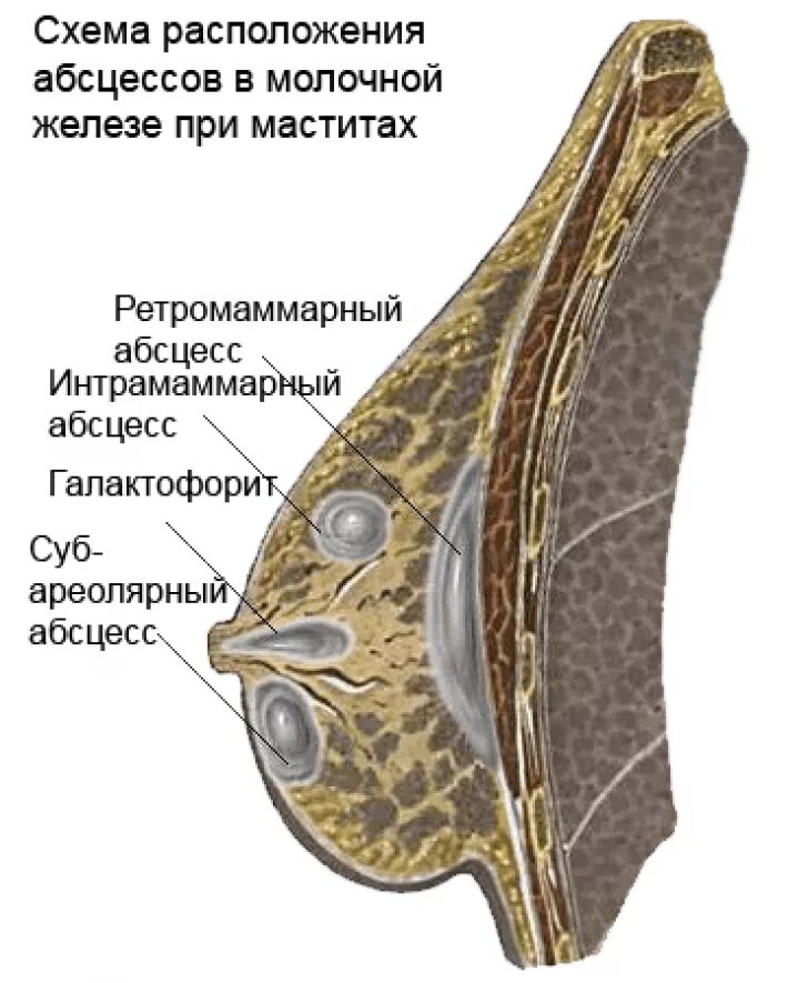 Послеродовый мастит. Ретромаммарный Гнойный мастит. Мастит абсцедирующая форма. Острый инфильтративный мастит. Молочные железы мастит.