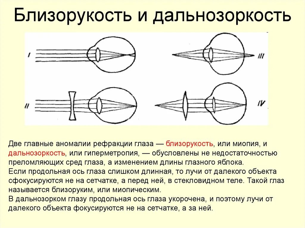 Дальнозоркость это когда. Дальнозоркость схема физика. Острота зрения близорукость и дальнозоркость. Линзы схема для близорукости и дальнозоркости. Линзы при дальнозоркости и близорукости физика.