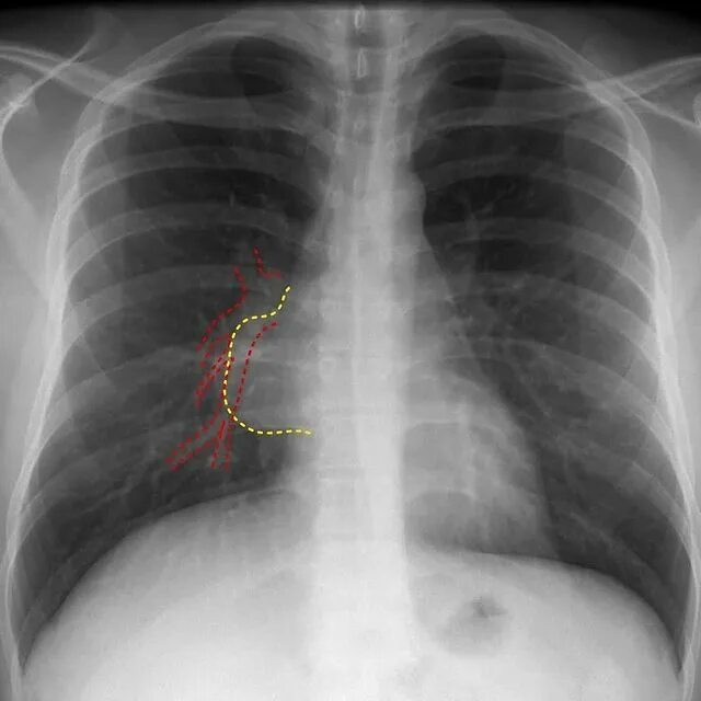 Кардио диафрагмальнаф липома. Липома при флюорографии. Абдоминомедиастинальная липома рентген. Липоматоз средостения рентген. Метастатический плеврит.