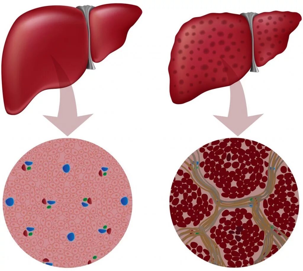 Клетки печени разрушаются. Мелкоузловой цирроз печени. Гепатитный цирроз печени.