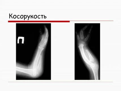 Врожденный травматологии