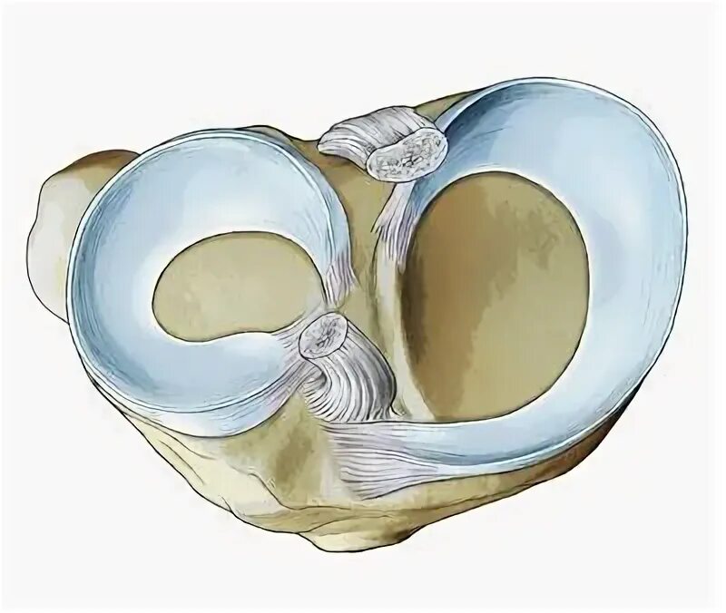 Менисцит медиального мениска коленного сустава что это. Повреждение разрыв медиального мениска коленного сустава. Разрыв мениска коленного сустава 3 а. Медиальный Рог медиального мениска. Структурные изменения медиального мениска
