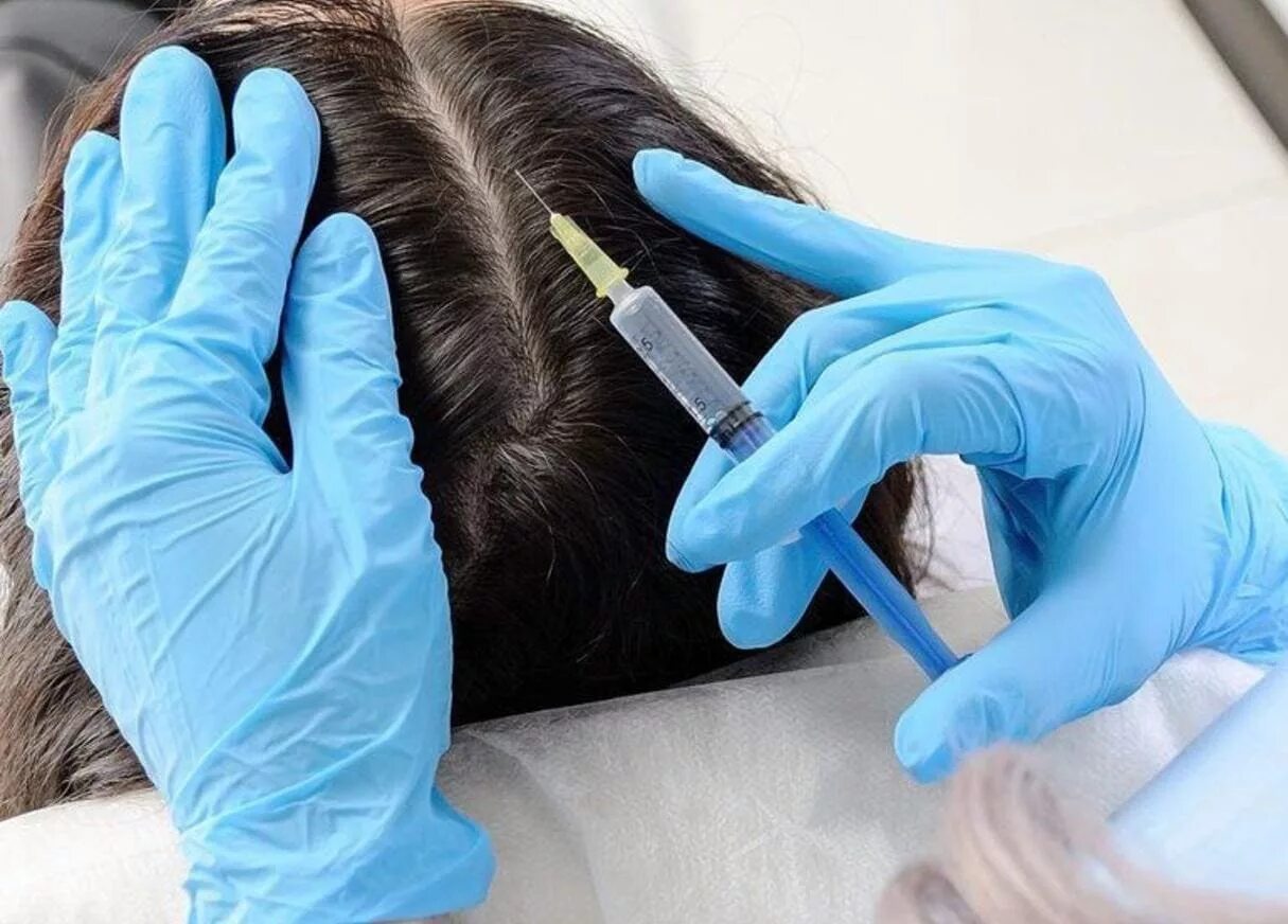 Инъекции головы. Мезо волосистой части головы. Мезо hair. Мезотерапия для волос. Мезотерапия кожи головы.