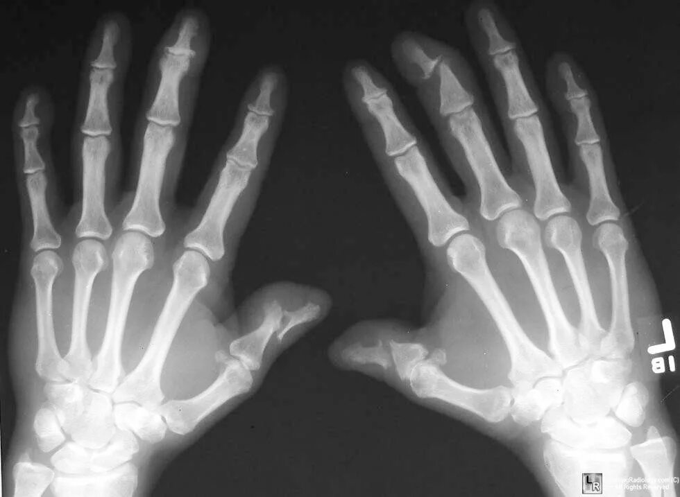 Pin on Arthritis Treatment