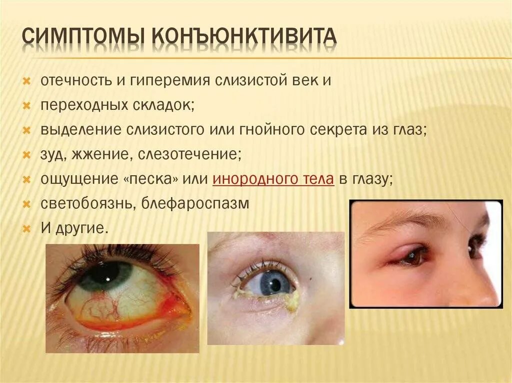 Конъюнктивит основные клинические проявления и симптомы. Конъюнктивит симптомы вирусный конъюнктивит. Глазное заболевание конъюнктивит симптомы. Симптомы конъюнктивита глаз