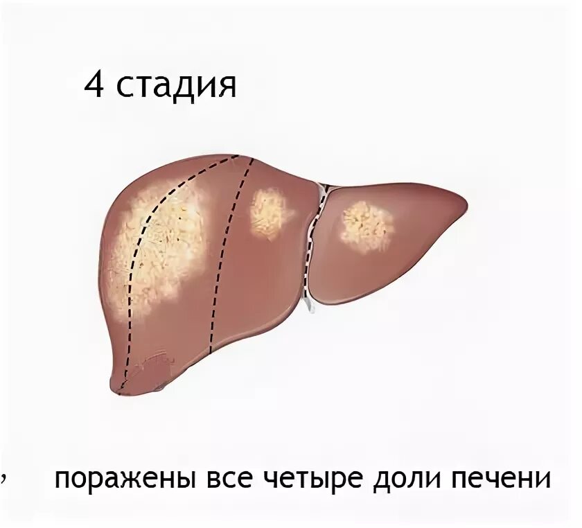 Онкология печени 4 стадия. Первая стадия печени