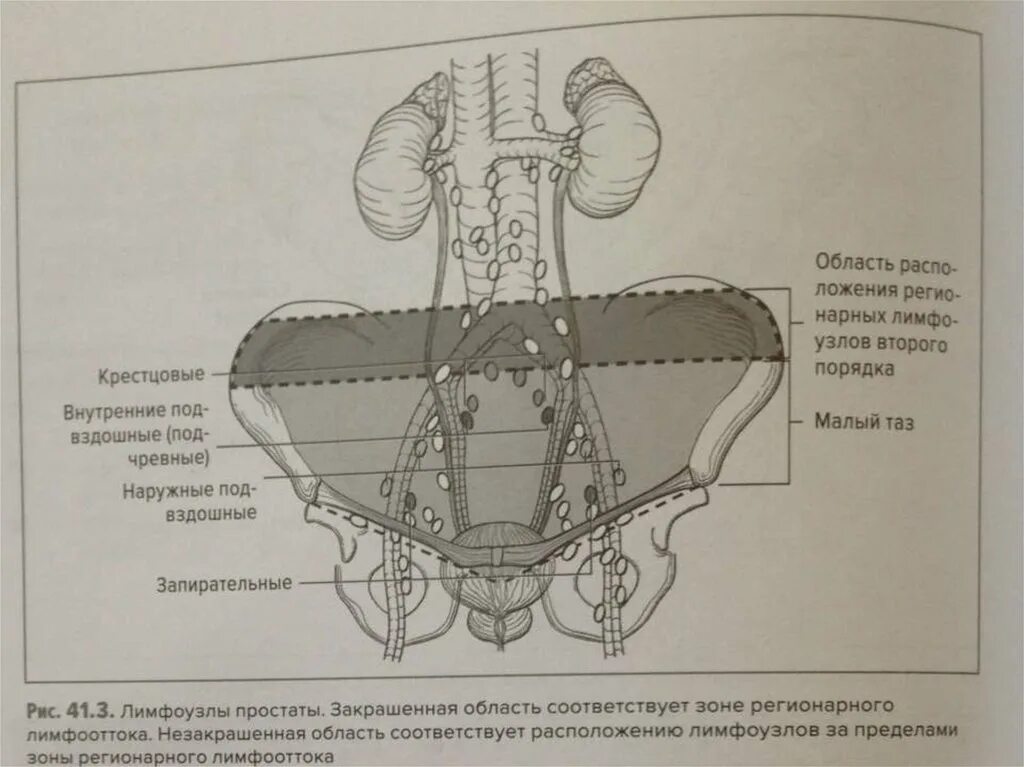 Простатэктомия простаты. Промежностная простатэктомия. Радикальная позадилонная простатэктомия ход операции. Радикальная простатэктомия (позадилонная, лапароскопическая);. Радикальная простатэктомия схема.