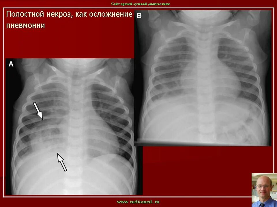 Полостное образование в легком. Синдром полостного образования в легких. Полостное образование в легком рентген. Полостные образования в легких