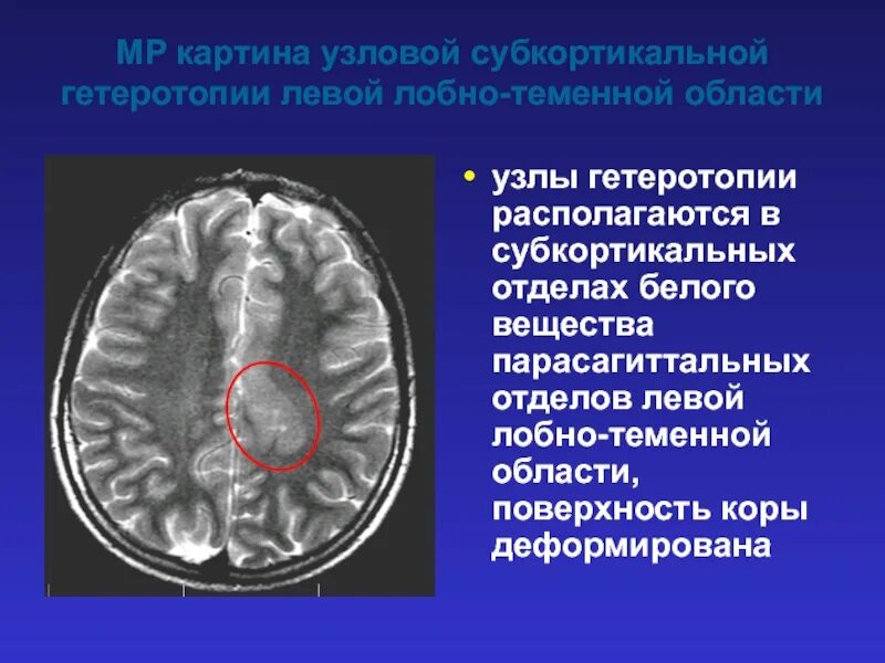 Единичный очаг в правой лобной доле. Субкортикальная гетеротопия. Гетеротопия серого вещества. Субкортикальные очаги головного мозга. Очаги в белом веществе лобных долей.