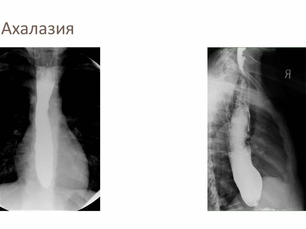 Ахалазия кардии пищевода рентген. Степени ахалазии кардии на рентгене. Халазия пищевода и ахалазия пищевода. Ахалазия пищевода студфайл. Халазия пищевода