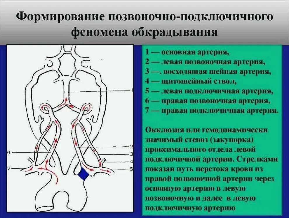 2 сегмент позвоночной артерии. Абберентная подключичная артерия плода. левая подключичная артерия сегменты. аберрантная левая подключичная артерия. стеноз левой подключичной артерии кт.