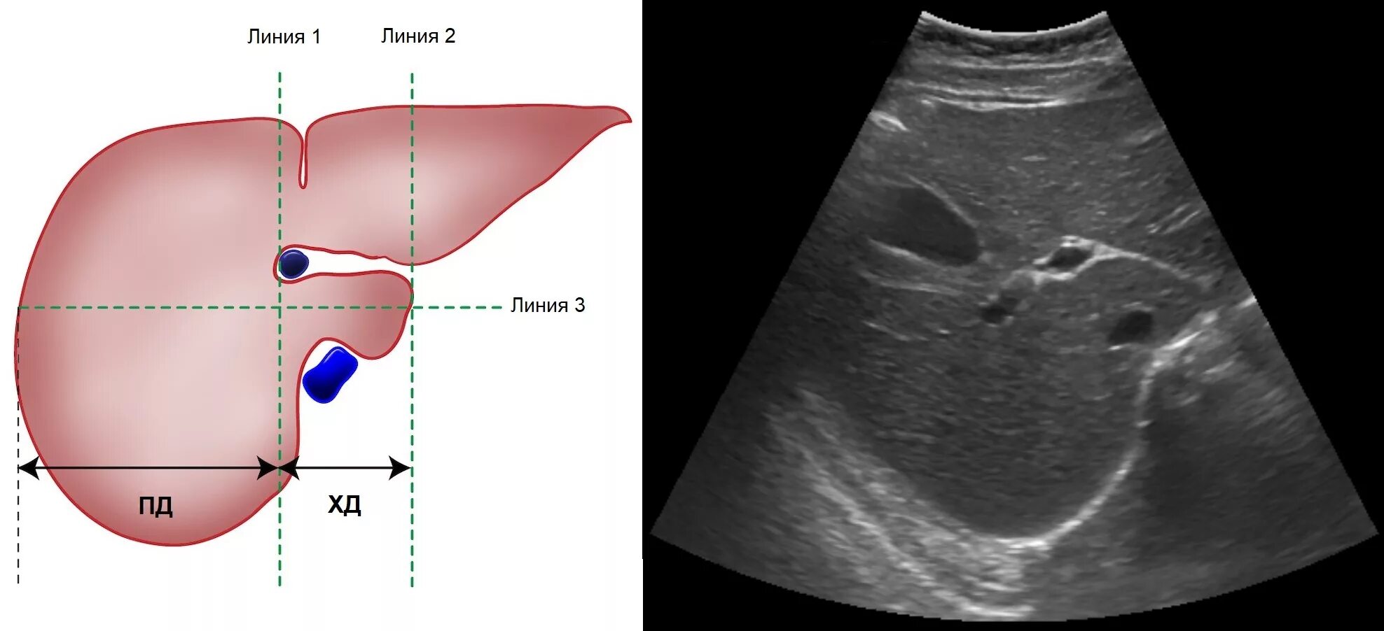Измерение правой доли печени на УЗИ. УЗИ печени Изранов. Измерение левой доли печени на УЗИ. Узи печени схема