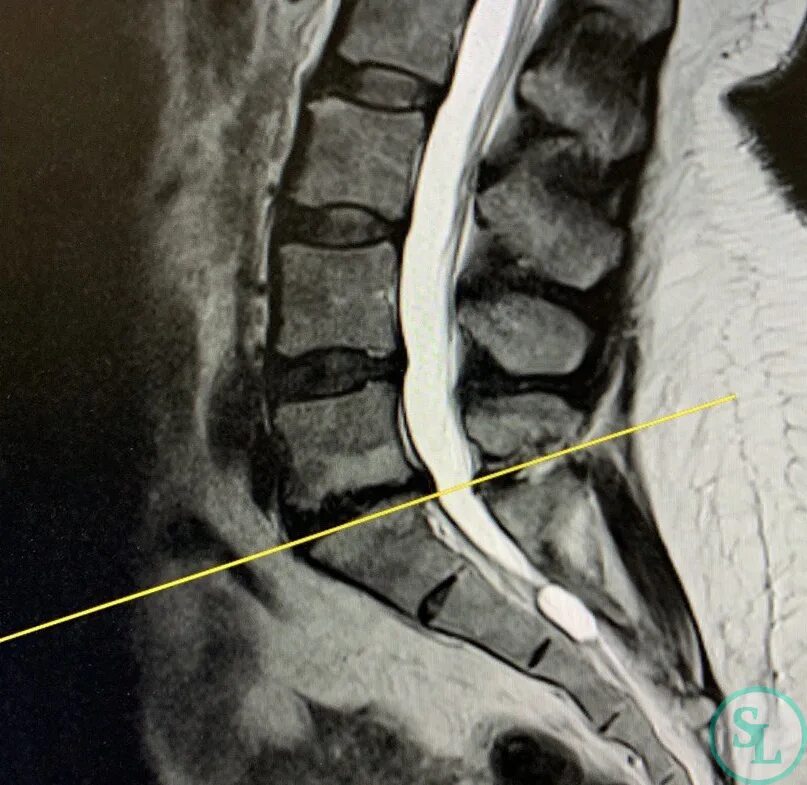Грыжа диска l5 s1 что это. L5-s1 отдел позвоночника схема. Грыжа диска l5/s1 поясничного крестцового отдела позвоночника. Грыжа l5 s1 пояснично-крестцового. Межпозвоночная грыжа поясничного отдела l5 s1.