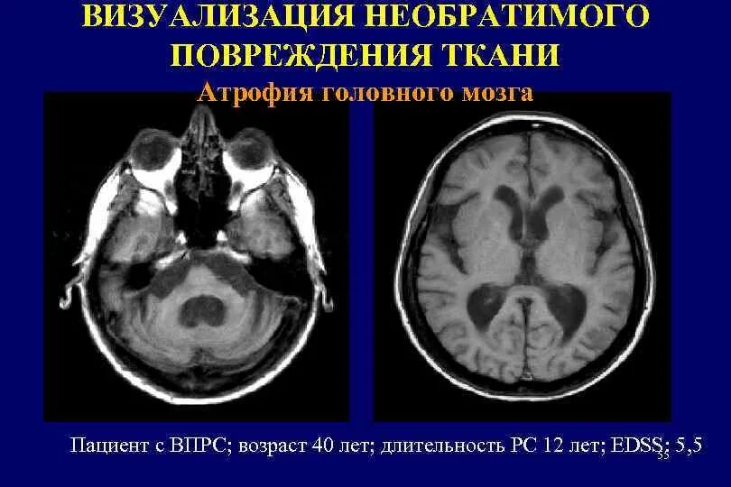 Атрофия вещества головного мозга. Атрофические изменения головного мозга кт. Атрофия головного мозга на кт. Необратимые изменения мозга