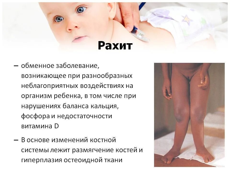 Что такое рахит и почему это исключительно детская болезнь: рассказала врач-педи