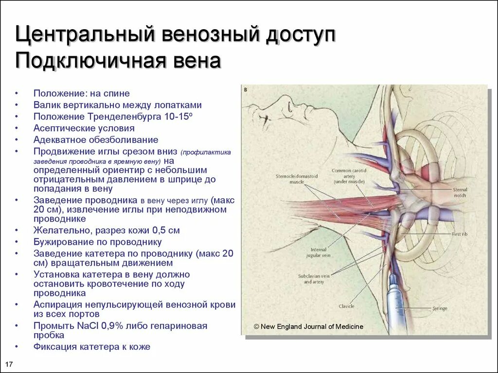 Центральный катетер в яремной Вене. Методика пункции подключичной вены. Катетеризация яремной вены ориентиры. Схема постановки подключичного катетера. Тромбоз подключичных вен