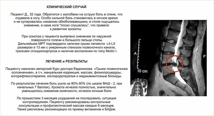 Грыжа Шморля поясничного отдела на мрт. Грыжа Шморля крестцового отдела. Стеноз поясничного отдела позвоночника. Гимнастика при стенозе позвоночного канала поясничного отдела.