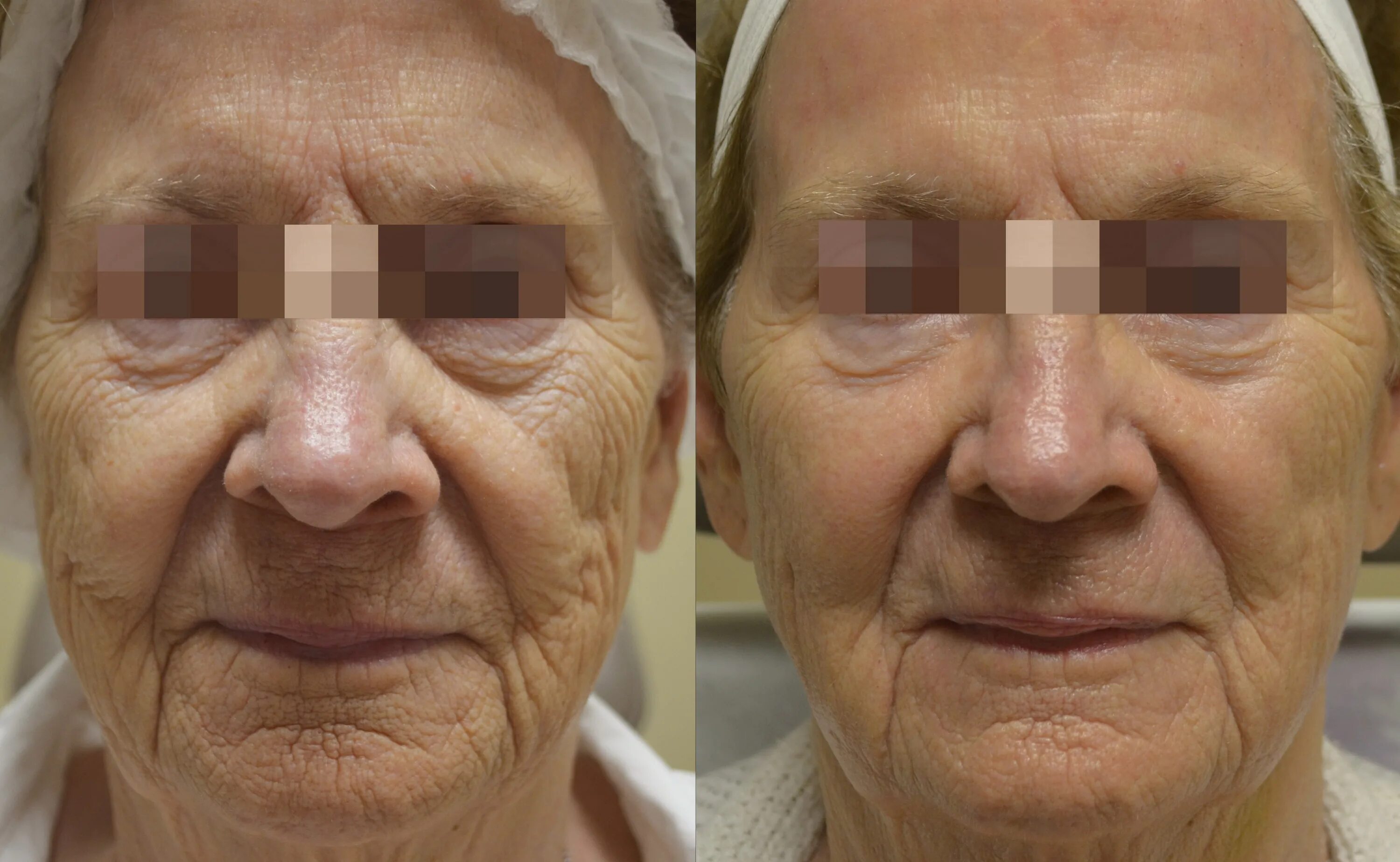 Морфеус аппарат до и после. Игольчатый лифтинг fractora. Рф лифтинг морфеус 8 до после. Фракционное радиочастотное омоложение morpheus 8. Рф лифтинг морфеус 8 до после.