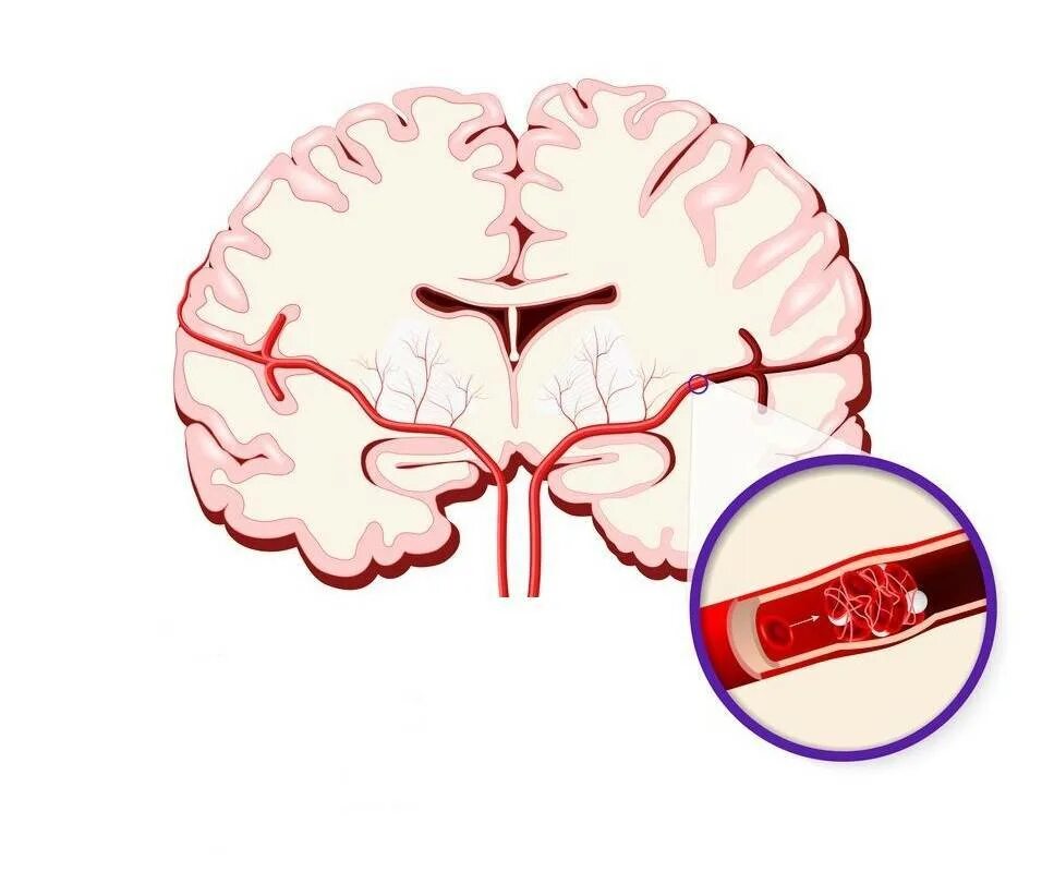 Сосудистые больные. Атеросклероз церебральных сосудов симптомы. Атеросклероз мозговых артерий симптомы. Поражение артерий головного мозга. Сосудистая патология мозга.