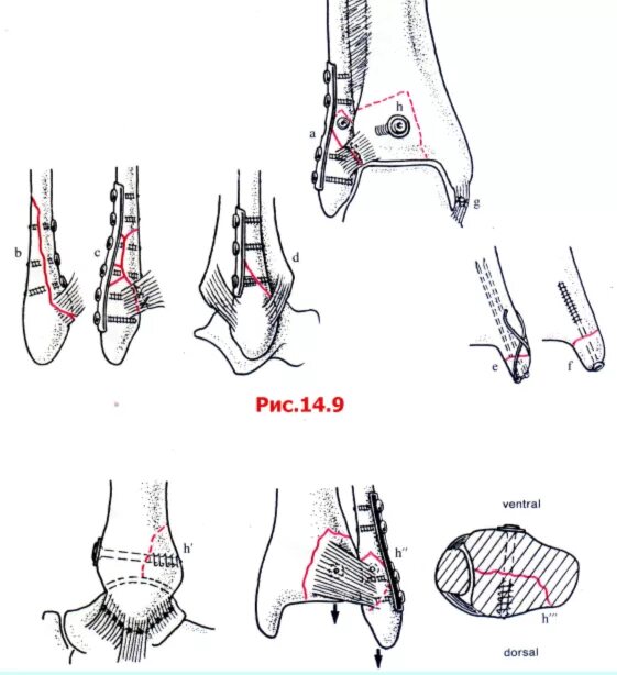 межберцовый синдесмоз рентген. перелом латеральной лодыжки операция. перелом лодыжки рентген. синдесмоз голеностопного. остеосинтез лодыжек пластиной и винтами.