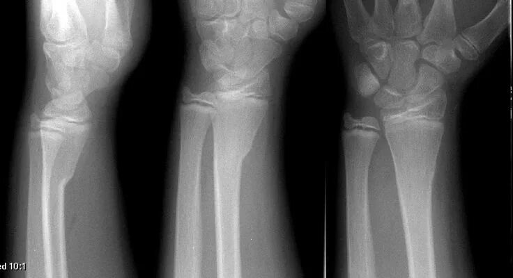 Radius fracture. Radius fracture