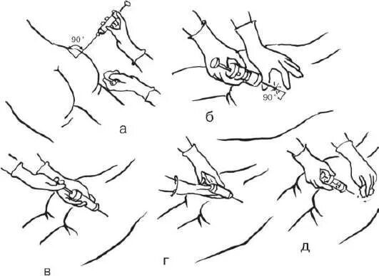 Как правильно держать шприц. Внутримышечная инъекция в ягодицу алгоритм. Техника введения внутримышечной инъекции в ягодицу. Техника введения внутримышечной инъекции в ягодицу алгоритм. Алгоритм постановки внутримышечной инъекции в ягодицу.