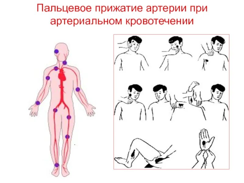 Пальцевое прижатие при кровотечении. Пальцевое прижатие при артериальном кровотечении. точки пальцевого прижатия артерий при кровотечении. точки прижатия артерий для остановки кровотечения. остановка артериального кровотечения пальцевым прижатием.