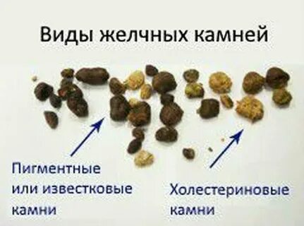 Камень в желчном пузыре какого размера опасен