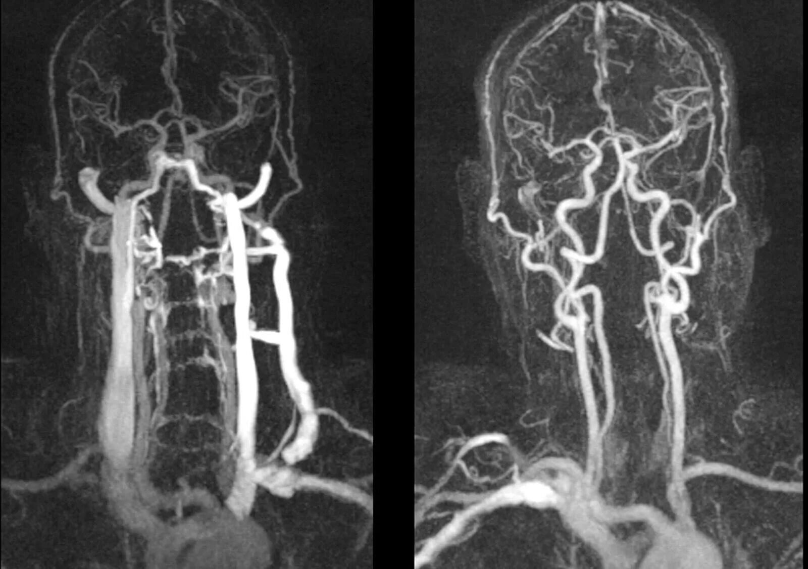 Венография головного мозга. Магнитно-резонансная ангиография артерий головного мозга. Мрт головного мозга с ангиографией. МРА (магнитно-резонансная ангиография). Кт ангиография сосудов головного мозга.