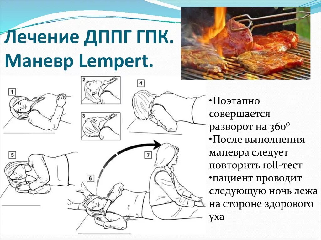 Дппг что это за болезнь. Пароксизмальное позиционное головокружение упражнение. Упражнения при доброкачественном позиционном головокружении. Лечебный позиционный маневр при головокружении. Упражнения при ДППГ.