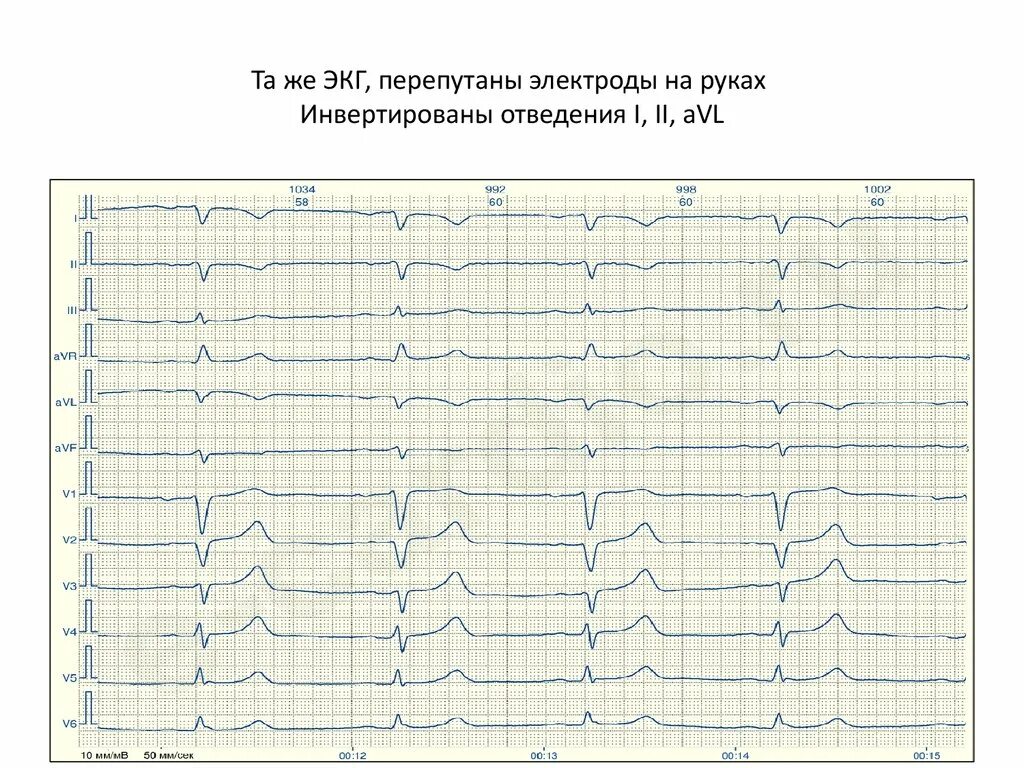 ЭКГ при неправильном наложении электродов. Неправильное наложение электродов на конечности на ЭКГ. Неправильно наложенные электроды на ЭКГ. Неправильное наложение электродов на ЭКГ. Отведение v1 на экг